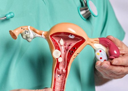 Endometriose: entenda o que é e qual o tratamento