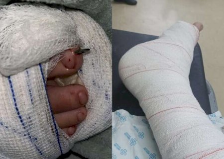 Crian&ccedil;a teve p&eacute; esmagado por pe&ccedil;a da Truck e passa por cirurgia junto ao pai