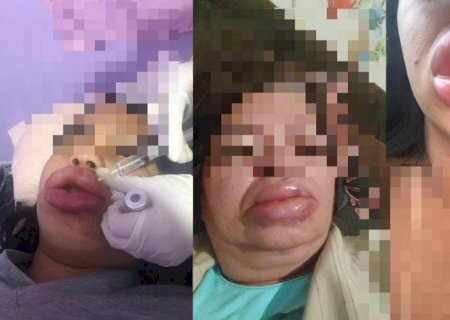 Falsa biomédica aplicou silicone em preenchimento labial