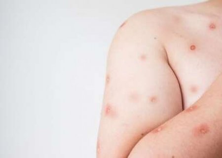 MS registra 20 casos de Mpox e m&eacute;dico faz alerta sobre cuidados