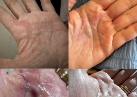 Mulheres denunciam pai de santo ap&oacute;s terem m&atilde;os queimadas com p&oacute;lvora