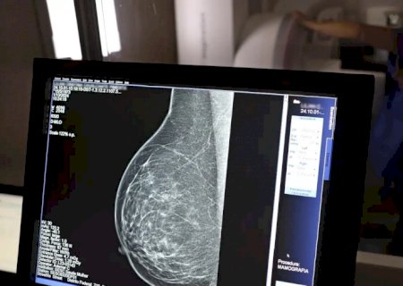 Ministério da Saúde passa a recomendar mamografia a partir dos 40 anos