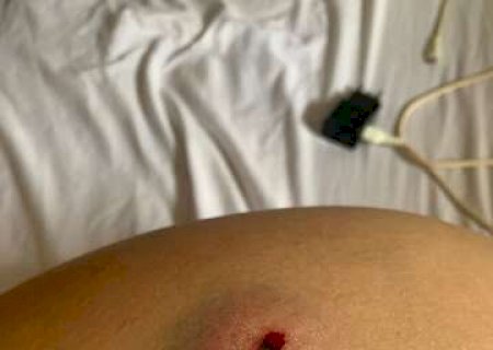 "Pavor&rdquo;, diz jovem atingida por tiro de chumbinho por motorista de aplicativo