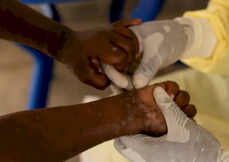 Brasil registra 88 casos de Mpox em 2026; saiba como evitar a doença