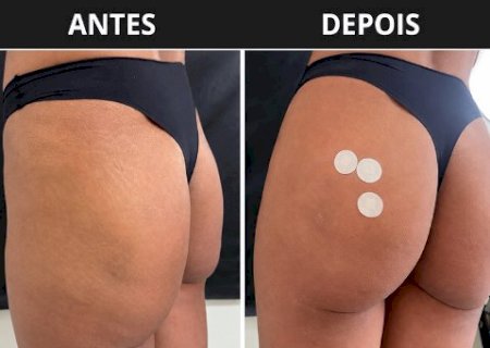 Harmoniza&ccedil;&atilde;o gl&uacute;tea foca em contorno natural ap&oacute;s emagrecimento com Mounjaro