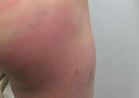 Padrasto &eacute; preso em flagrante por espancar menino de 5 anos com galho de amora