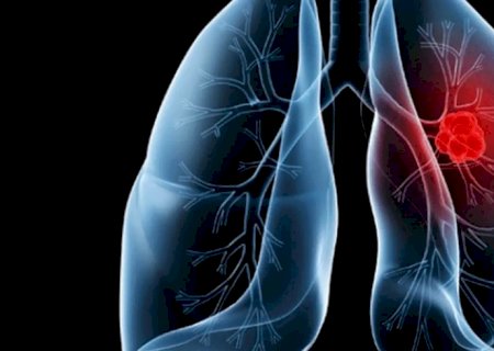 Saiba o que é adenocarcinoma pulmonar, câncer que atinge o papa